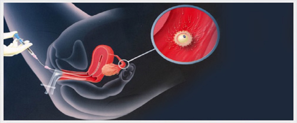 icsi ivf in ahmedabad